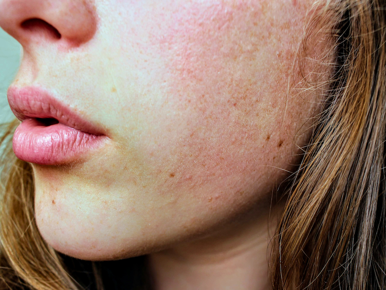 Hautbild peri Dermatitis